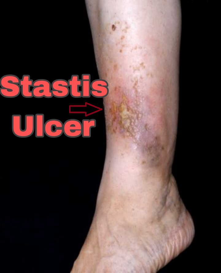 website logo venous ulcer